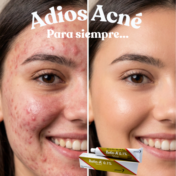 Retin-A 0.1% Crema (Tretinoína) - Tubo 40g - Laboratorios Janssen